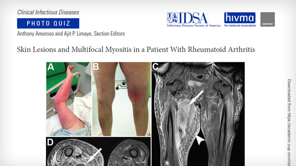 Skin Lesions and Multifocal Myositis in a Patient With Rheumatoid Arthritis